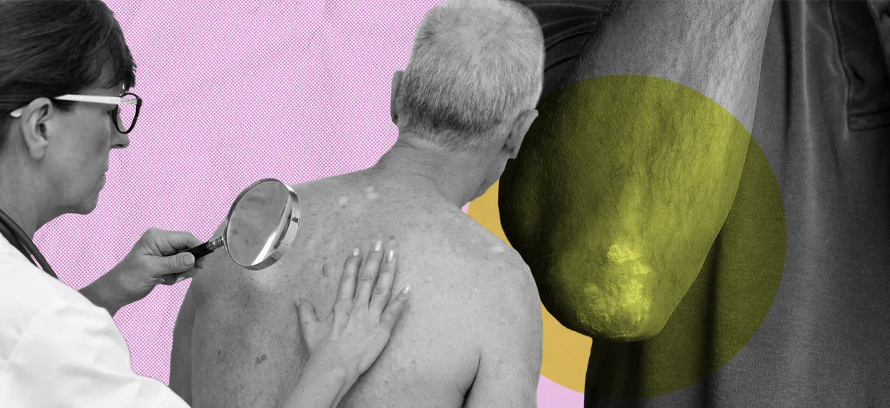 Лишай у человека