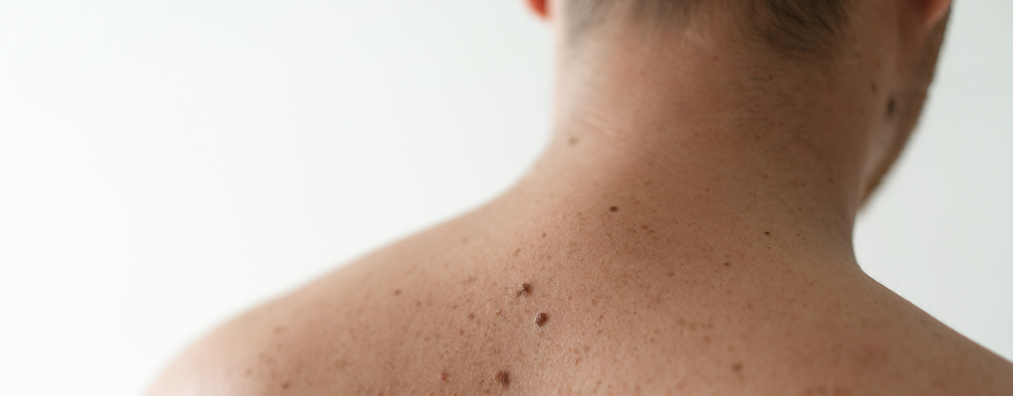 Главные мифы о родинках!