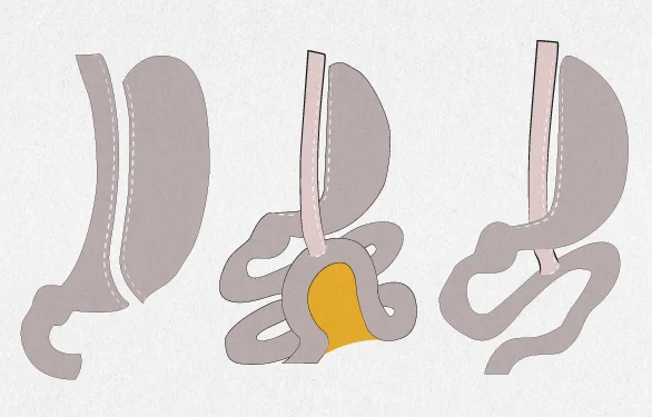 Бариатрическое лечение