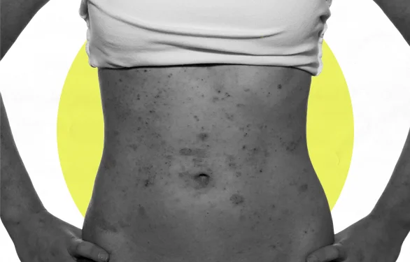 Красный плоский лишай