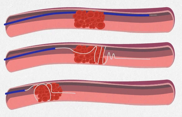 лечение ишемического инсульта