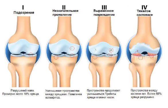 Стадии артроза