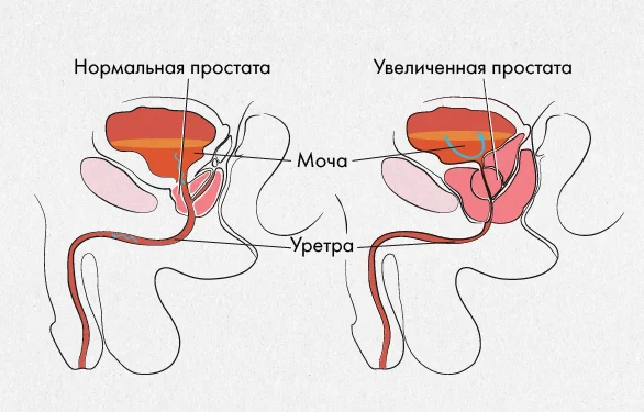 Виды простатита