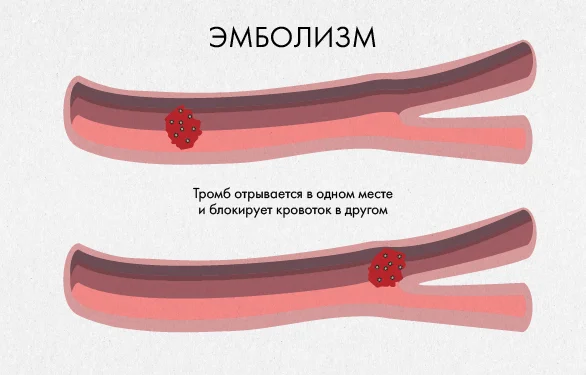 эмболизм