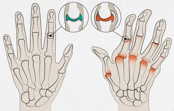 Признаки артроза