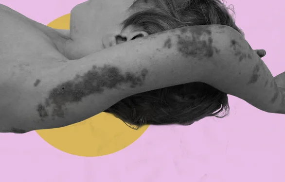 Опоясывающий лишай