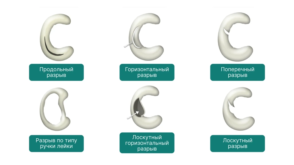 мениск RIP 2- 1_1.webp мениск RIP 2- 1_1.webp