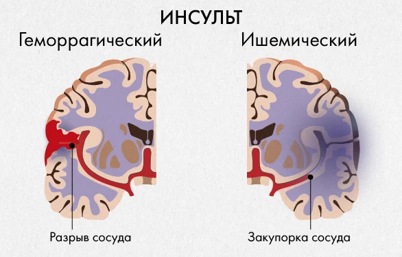 головной мозг в разрезе