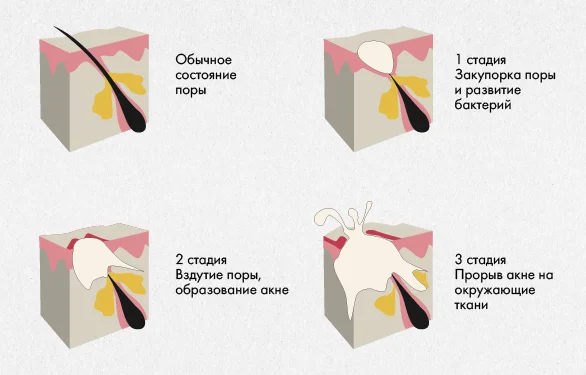 2patogenez furunkula.webp