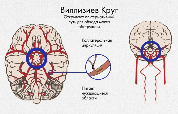 патогенез ишемического инсульта