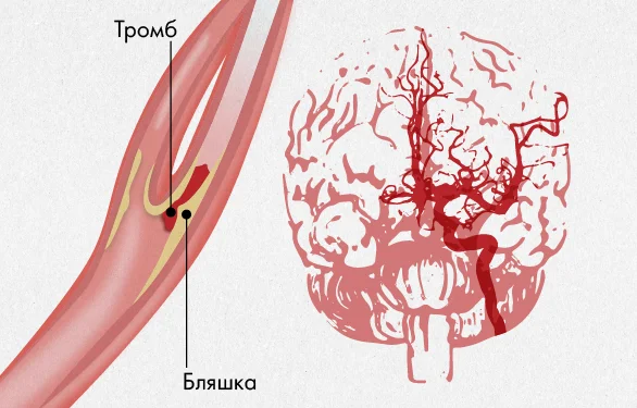 причины инсульта