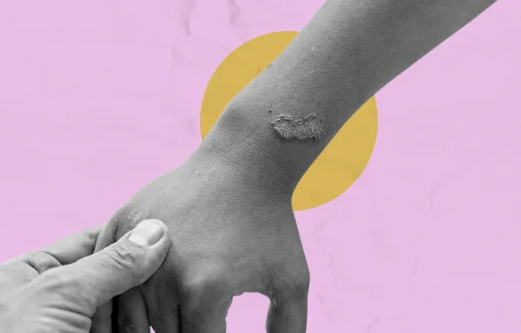 Лишай на руке