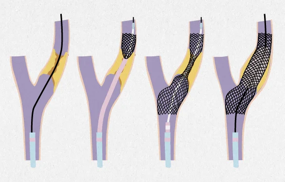 удаление тромба