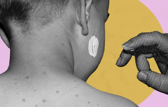 лечение лишая