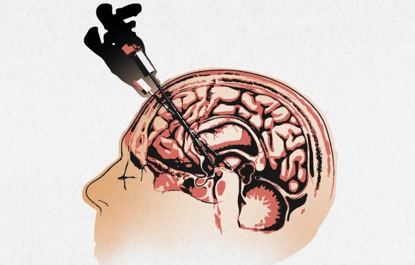 лечение инсульта